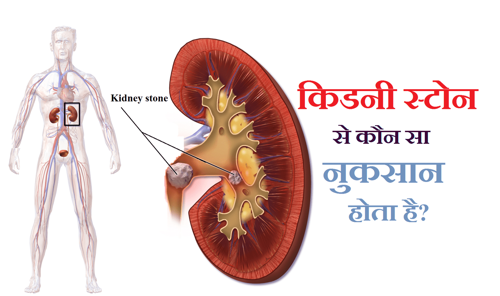 किडनी स्टोन में क्या खाना चाहिए, किडनी स्टोन ट्रीटमेंट इन होमियोपैथी इन हिंदी, किडनी स्टोन के नुकसान, पथरी क्या खाने से होती है, पथरी के कारण कौन सा रोग होता है, फिटकरी से पथरी का इलाज, गुर्दे की पथरी के नुकसान, पथरी तोड़ने की दवा, 24 घंटे के भीतर गुर्दे की पथरी के लिए घरेलू उपचार प्राकृतिक हटाने, पेशाब नली में पथरी की दवा, पथरी तोड़ने की दवा Homeopathic, पथरी की देशी दवा, पथरी की अंग्रेजी दवा, पतंजलि की पथरी की दवा, पथरी की होम्योपैथिक दवा, बियर से पथरी का इलाज,