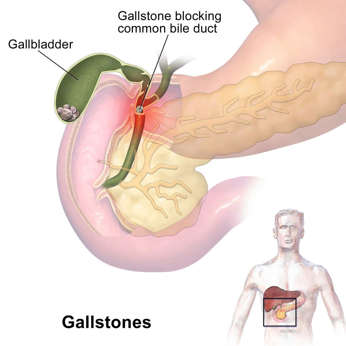 kidney gall petSTONE